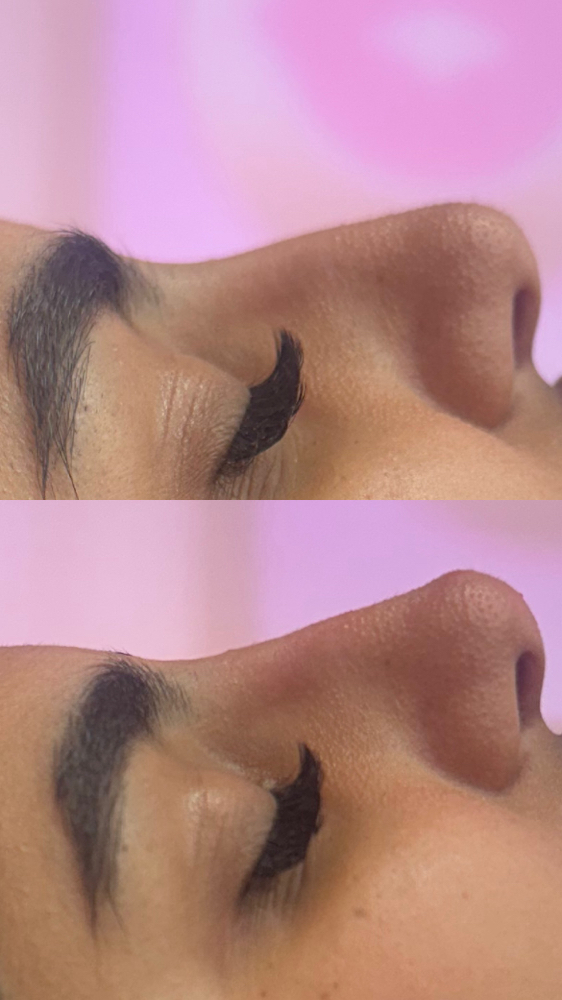 Non Surgical liquid Rhinoplasty