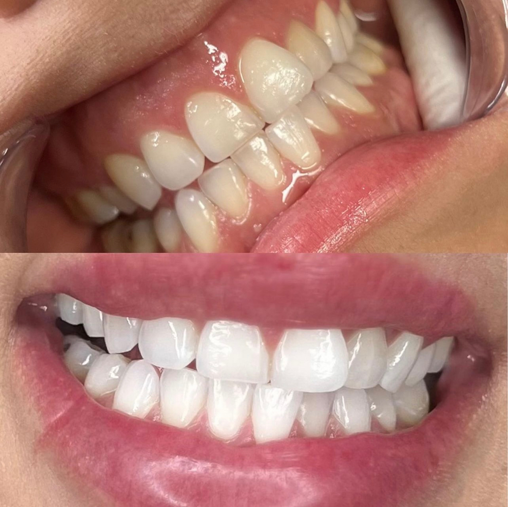 TEETH WHITENING