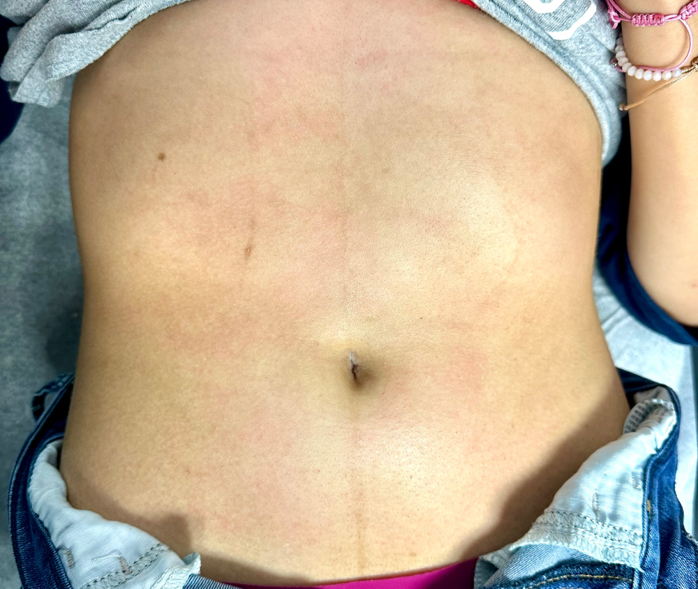 Full Stomach Wax at Chosen Esthetics in Pasadena, TX