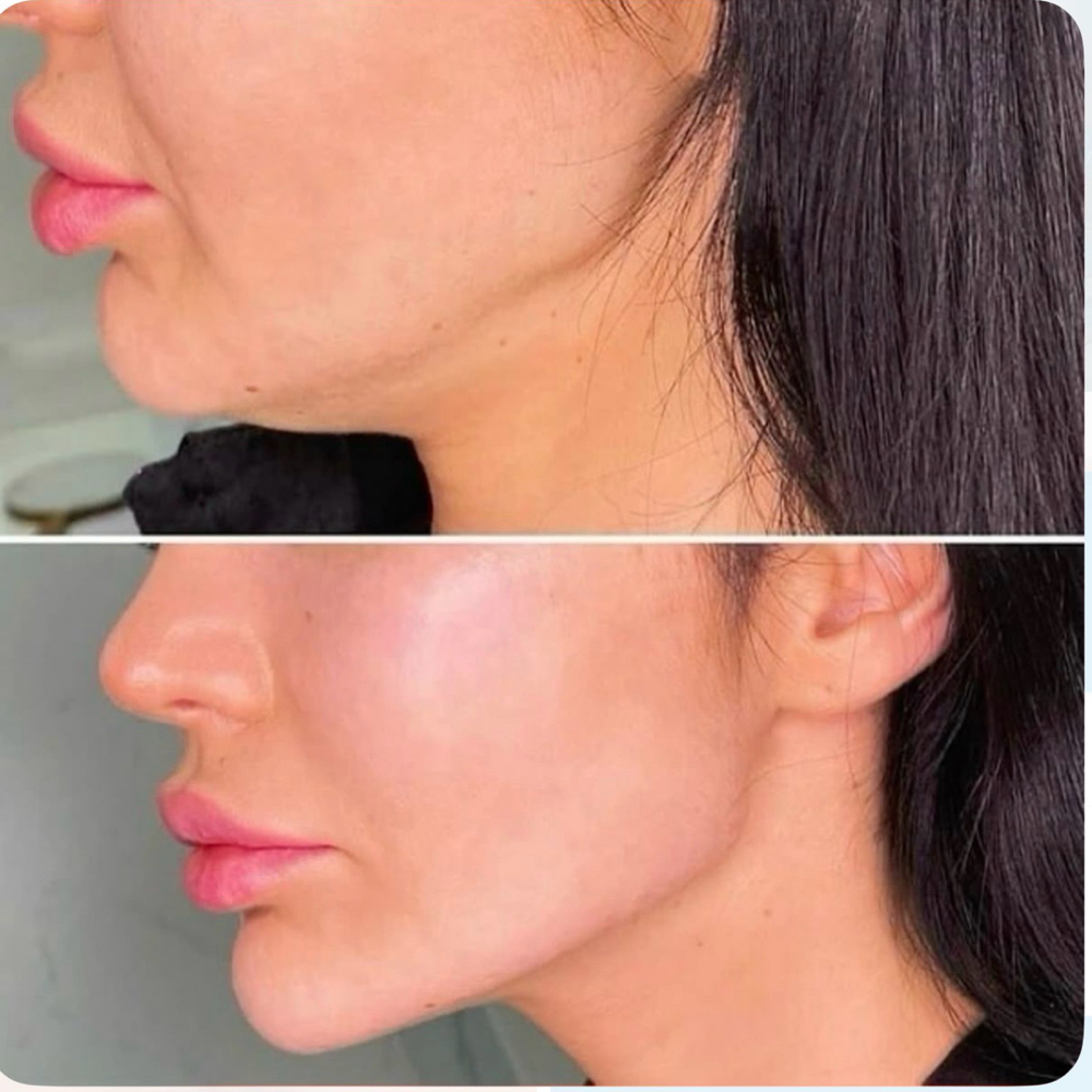 Armonizacion Facial at SWEET BODY in San Antonio, TX