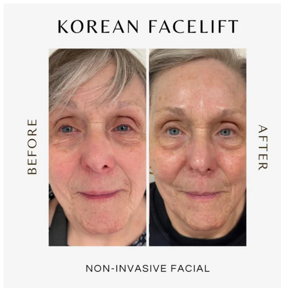 Korean Facelift Facial