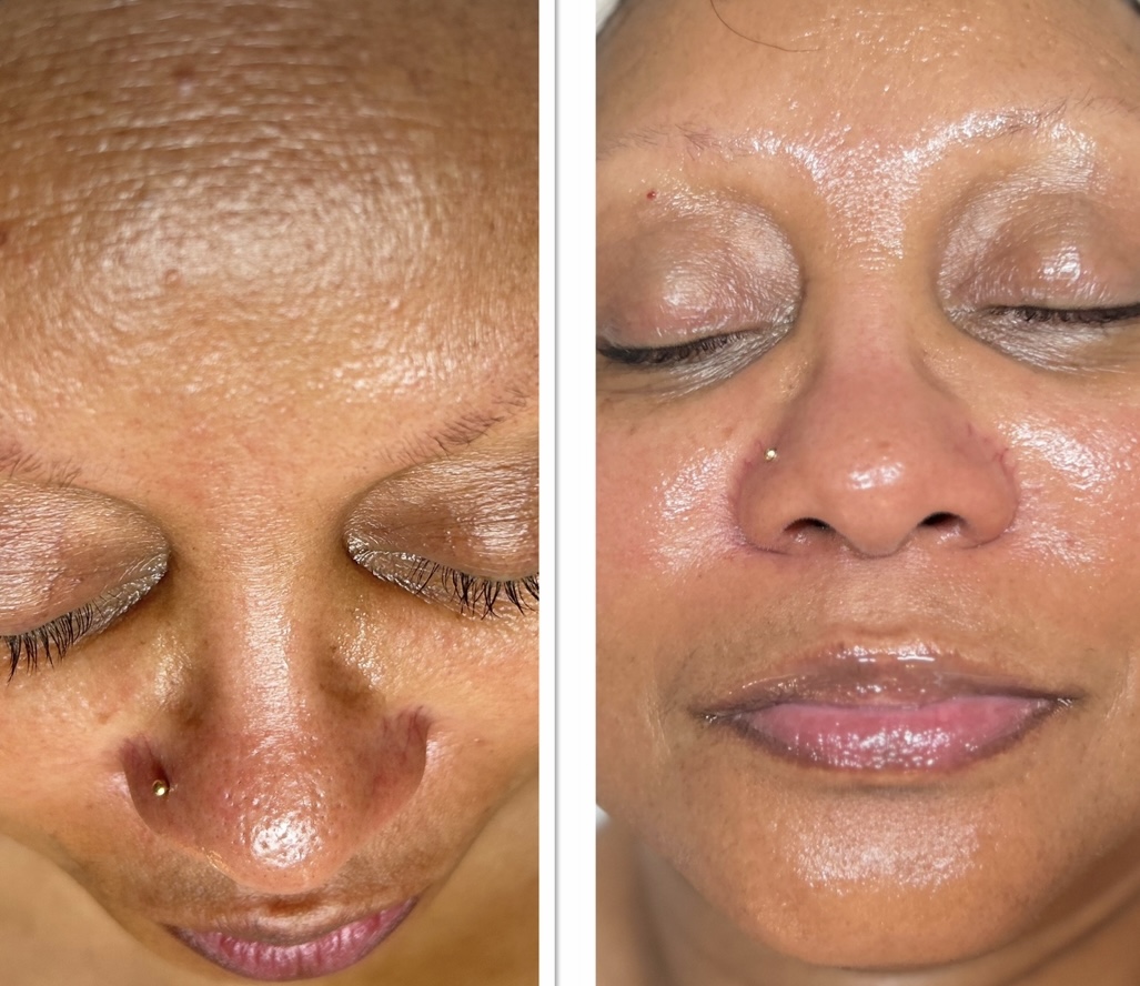 Deluxe No Peel, Peel Facial