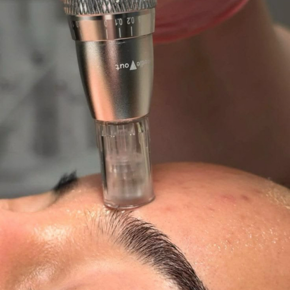 Customized Microinfusion Facial at Adelina Aesthetics in Old Bridge, NJ