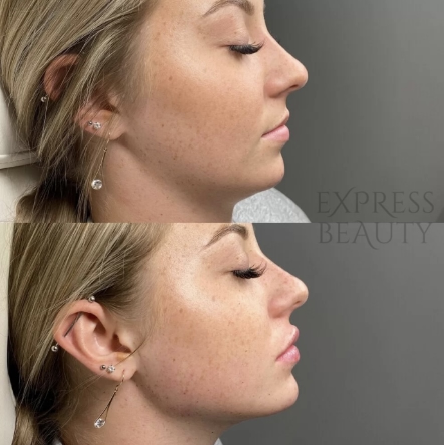 🧏🏻‍♀️Jawline & Chin Duo