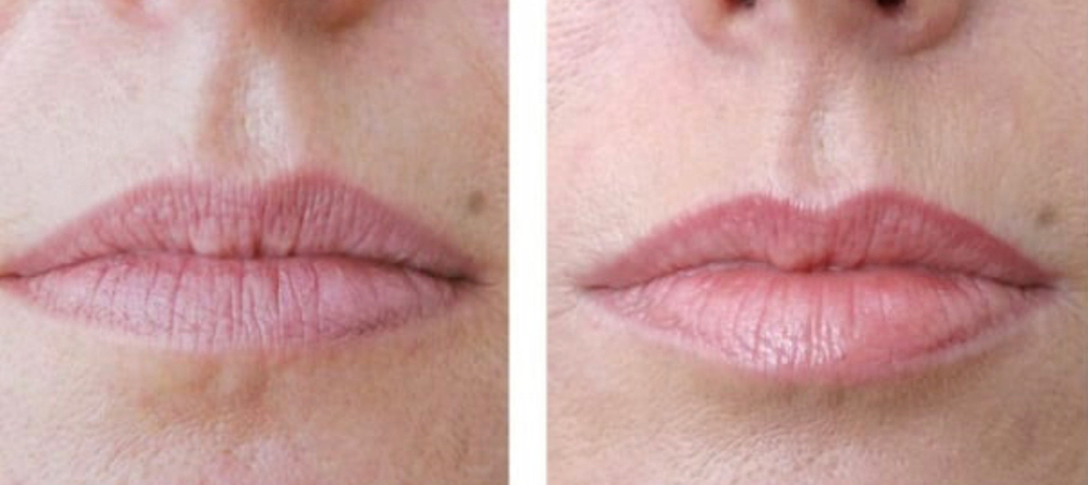 Dermal Filler 2-week follow-up