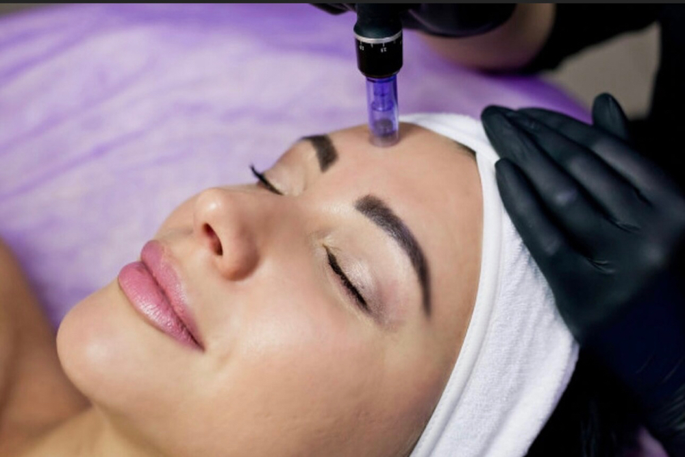 Micro Needling Per Session