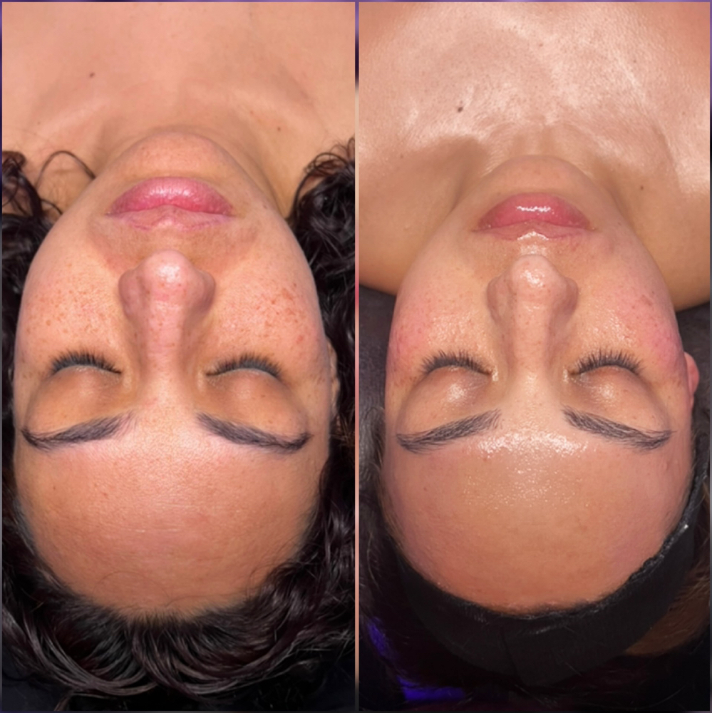 Custom Chemical Peel