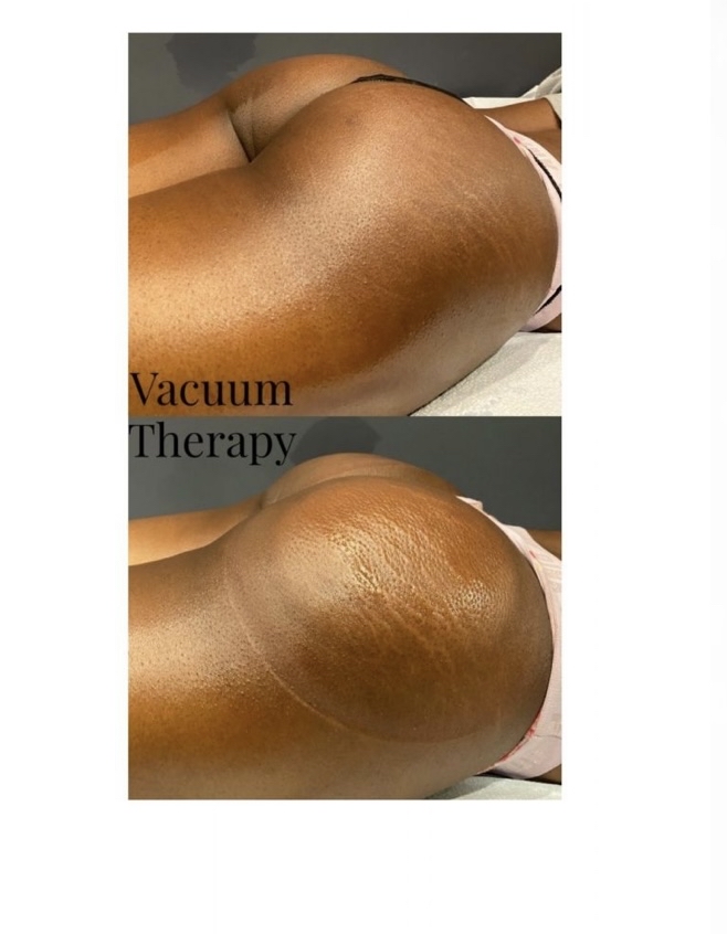 Butt Cupping 5 Treatments