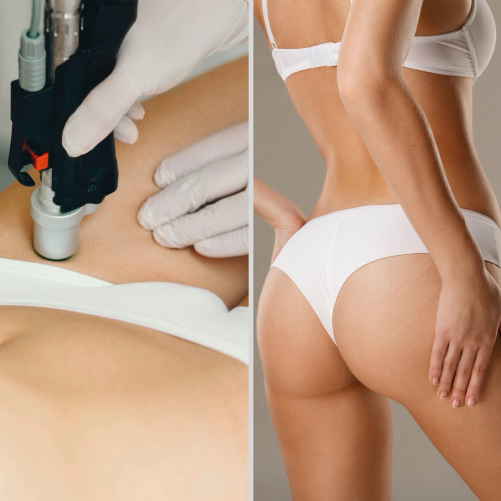 Brazilian Laser- Single Session at SLS Laser Medspa in Ontario, CA