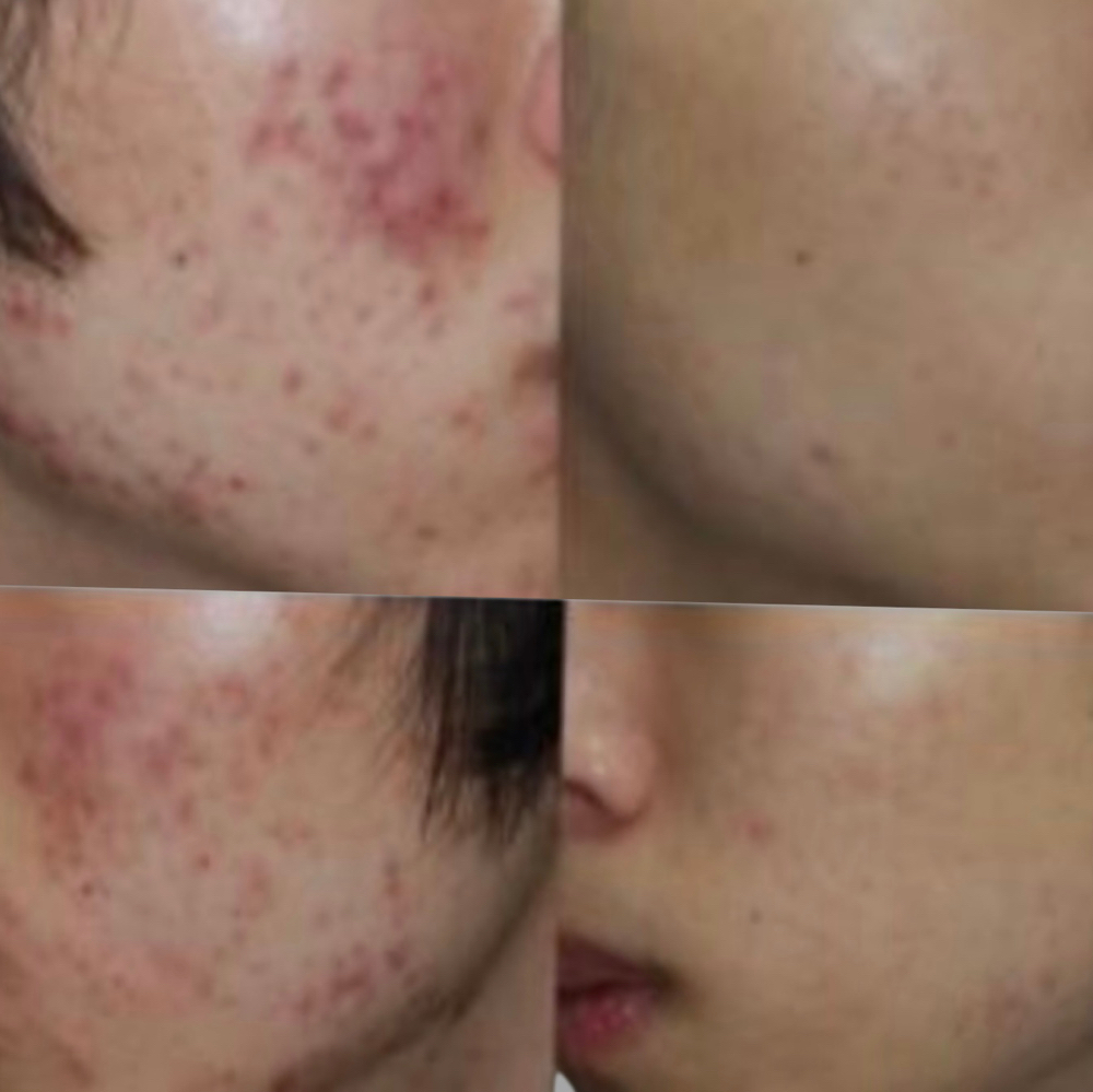 Acne Therapy Facial Treatment