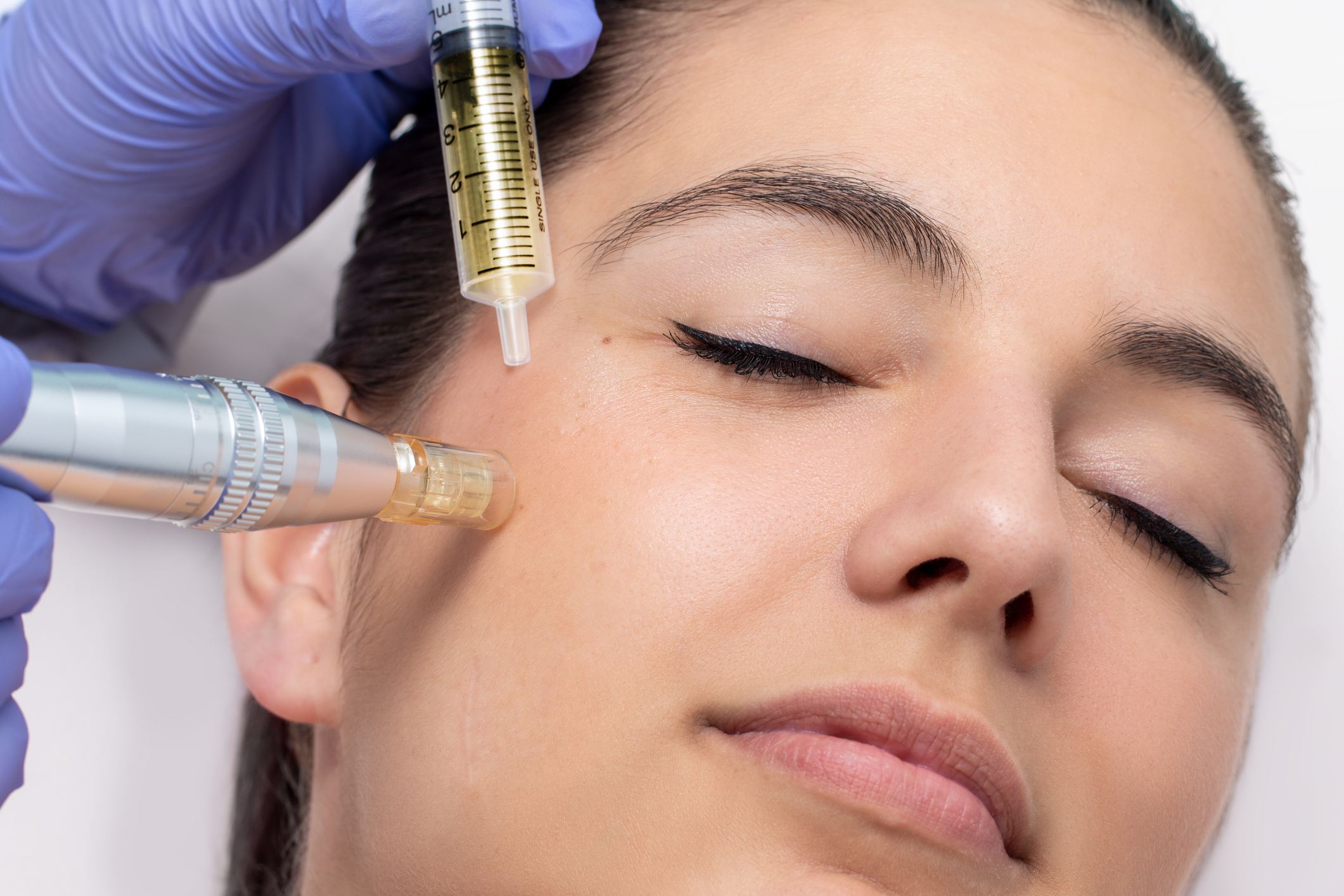 Microneedling with Pro-Xo® Exosomes
