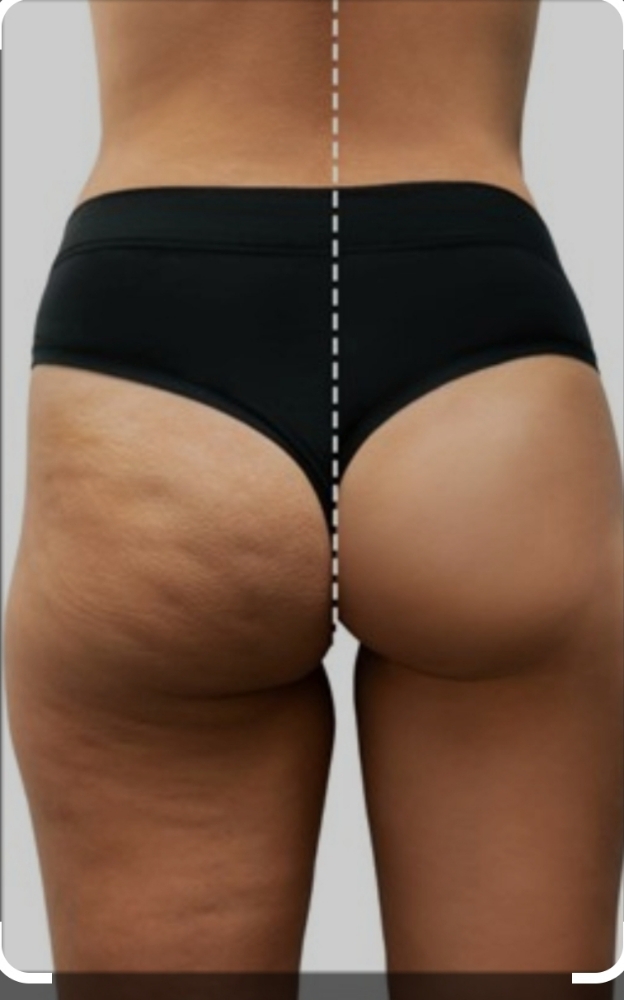 BBL With Lift Package Of 3