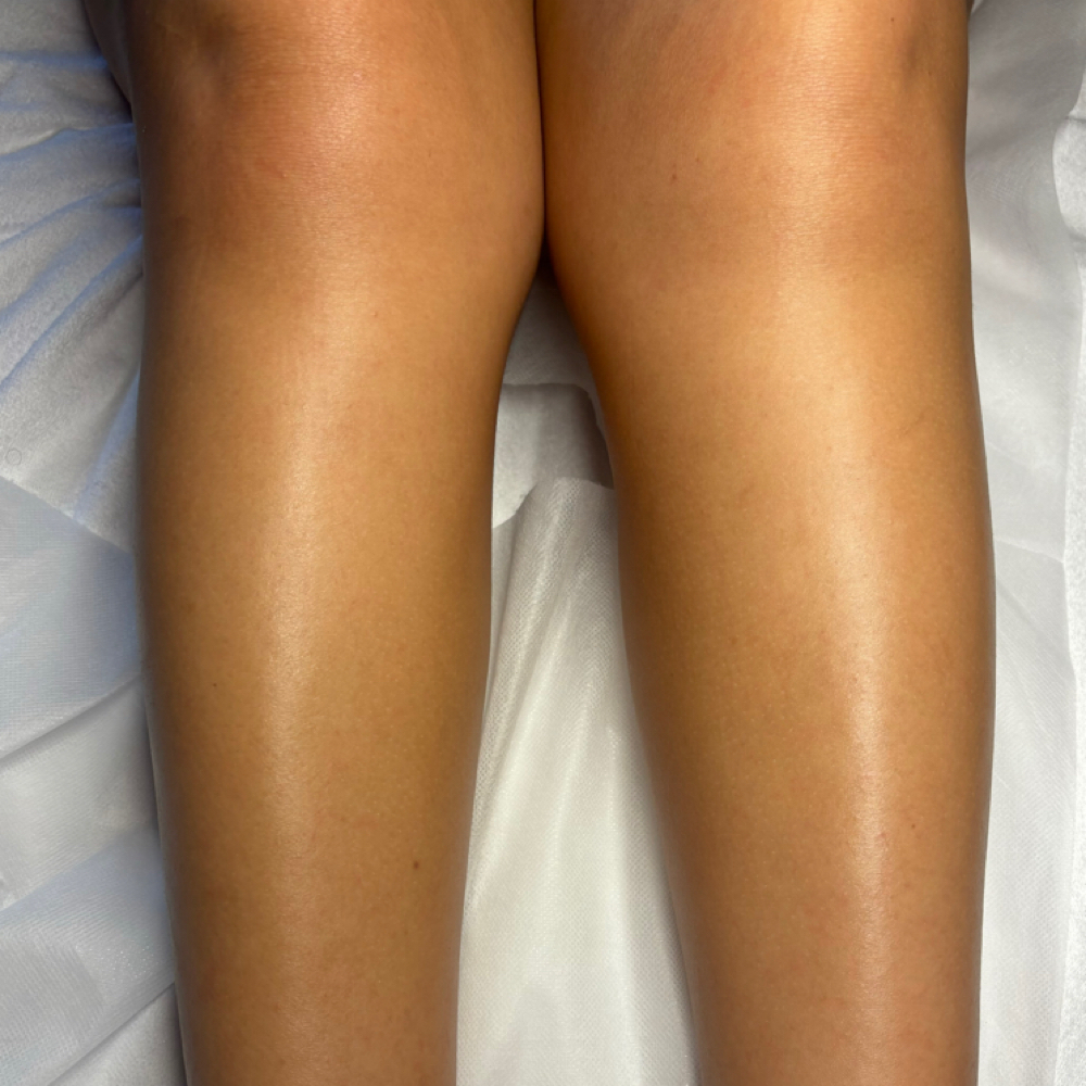Half Leg Wax at Pearly Derm in Sun valley, CA