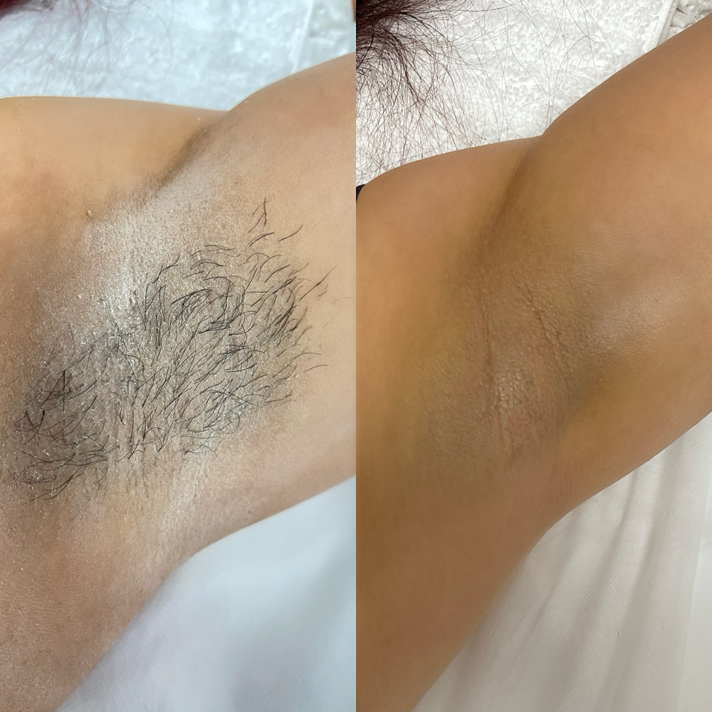 Underarm
