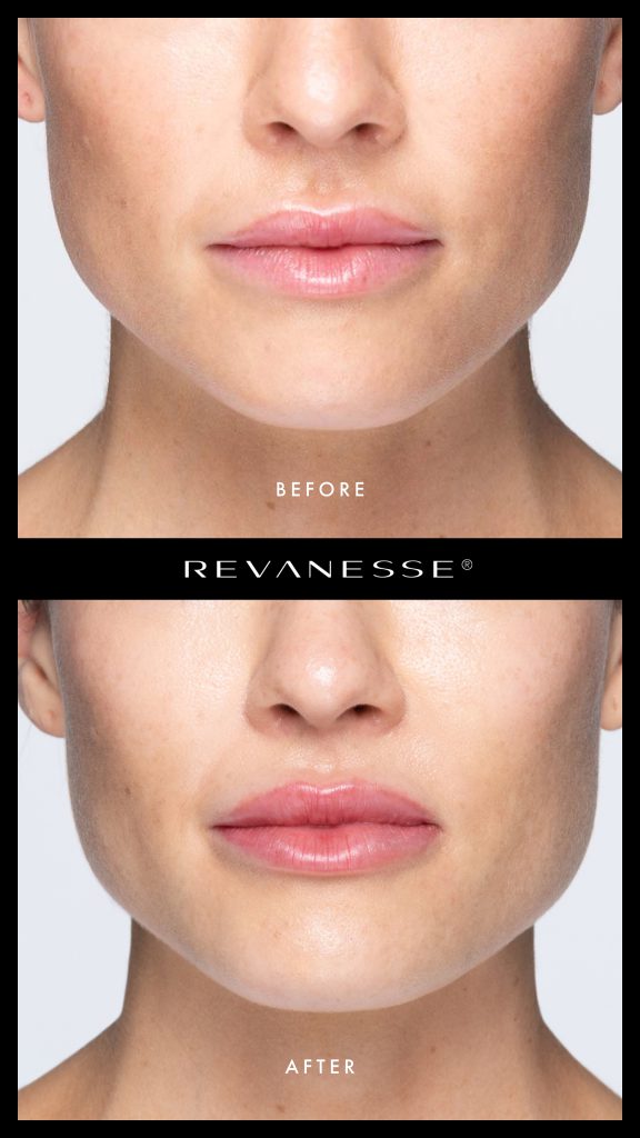 Revanesse lip filler VERSA