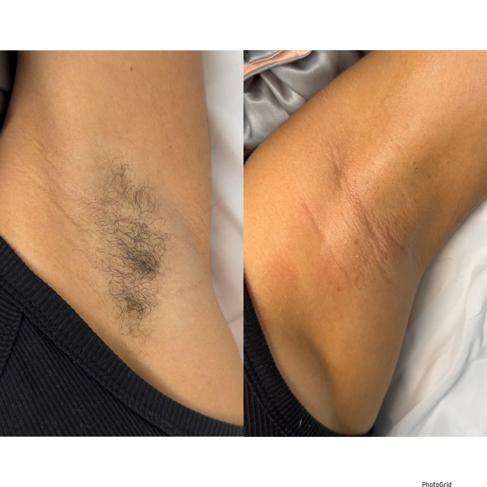 Under Arm Wax Hair Removal