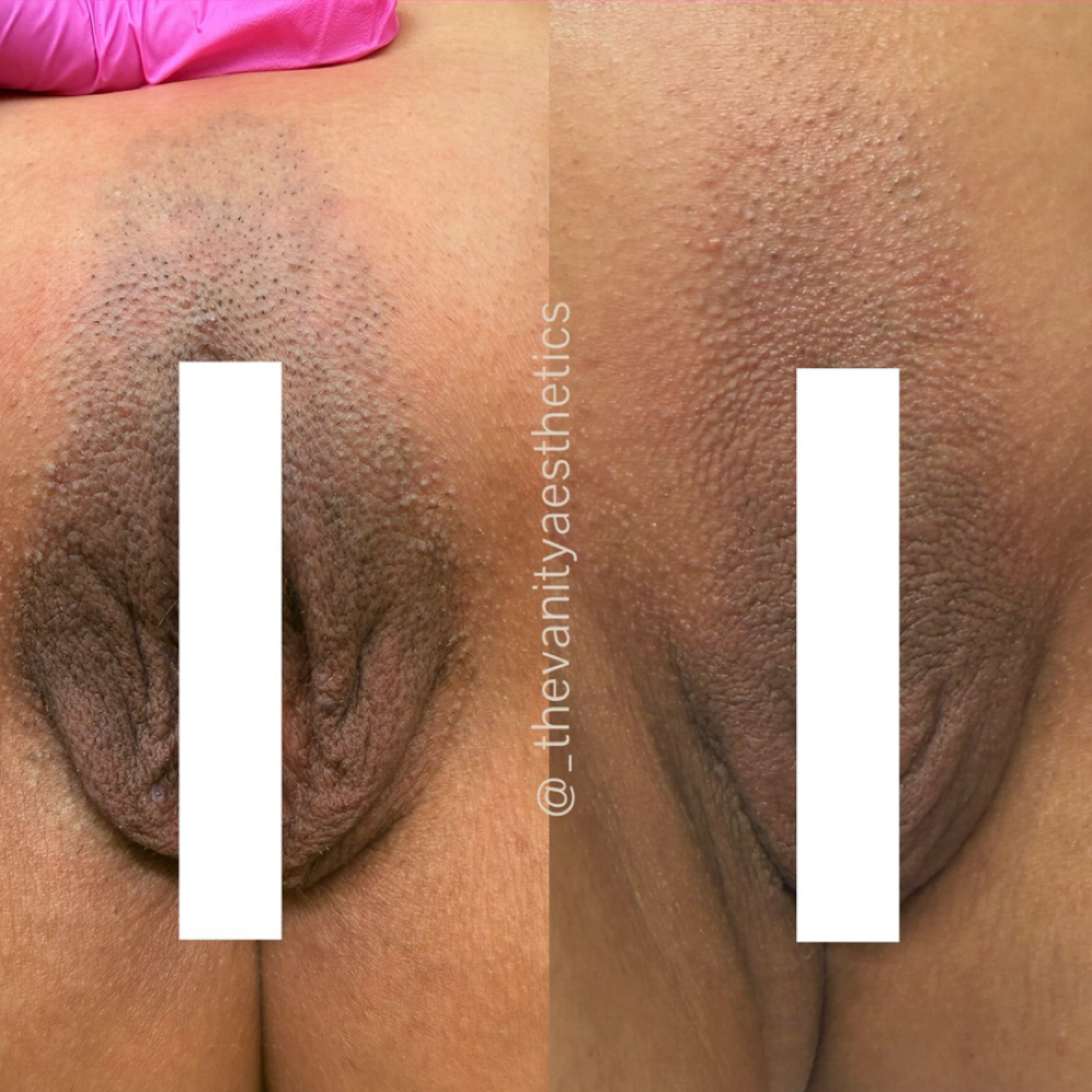 Vaginal Rejuvenation at The Vanity Aesthetics in Spring Branch, TX