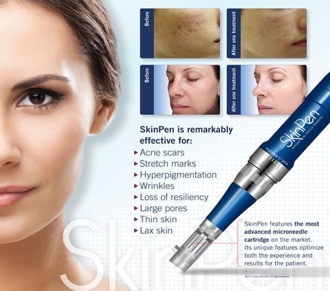 Skinpen Microneedling