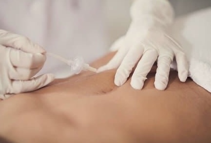 CO2 Sculpt at Zoraya Velez AESTHETICIAN in Richmond, VA
