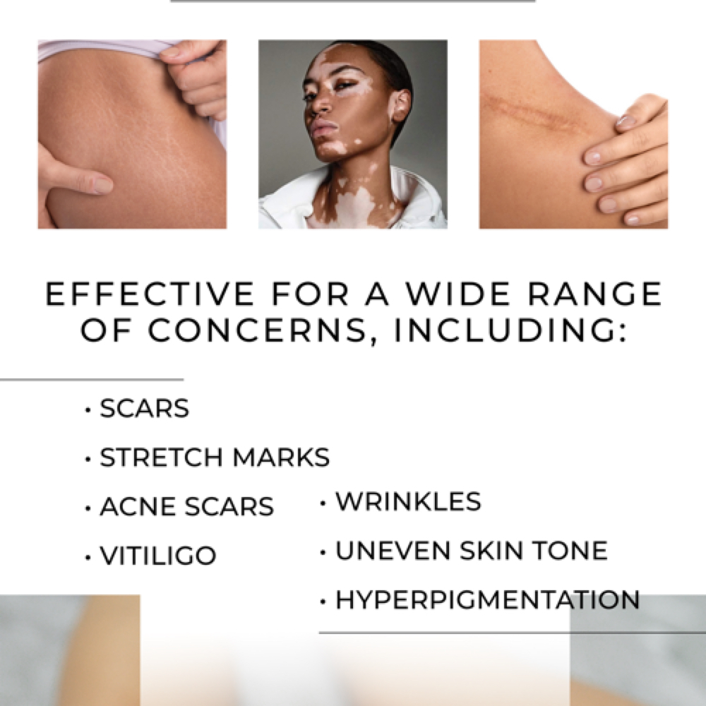 Scar + Stretch Mark Camouflage at Reiss Beauty by Renée Bradlee in La Mesa, CA
