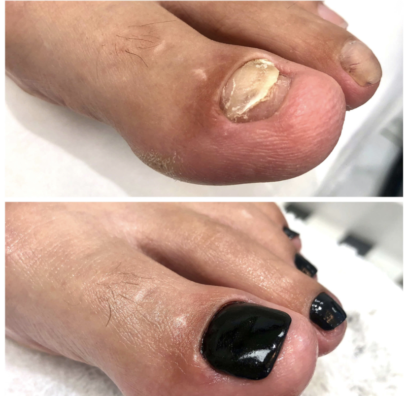 Reconstruction of Toes