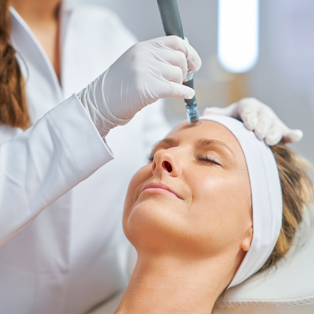 MicroNeedling Treatment