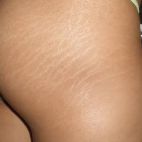 BUTTOCKS STRETCHMARKS at Deesignz Lash & Brow Studio in Lagrange Park, IL
