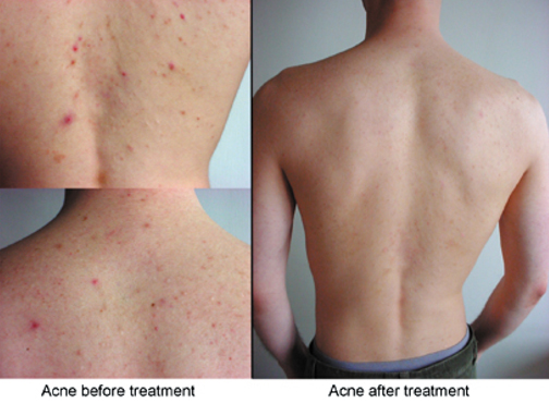 Back Facial