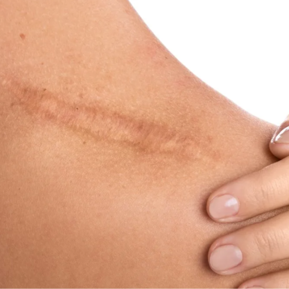 Scar Lightening at bodystretchmark in dallas, TX