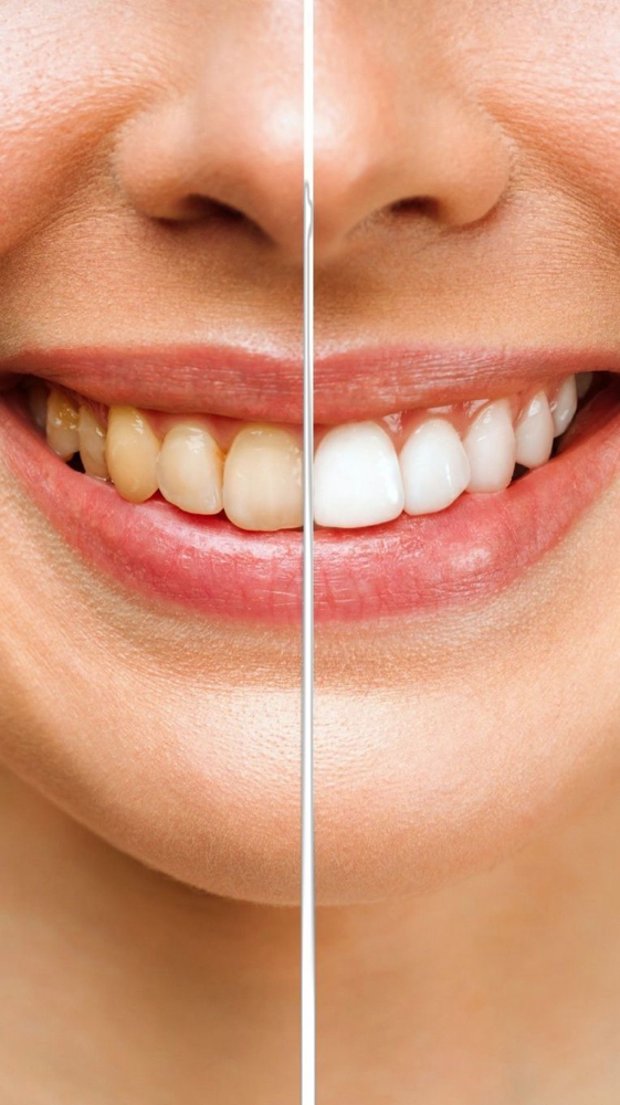 Clareamento Dental (sem Dor) at Jessica Luchesi Skin Wellness in Elizabeth, NJ