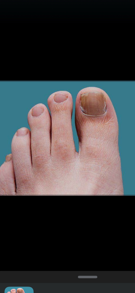 Onychomycosis (Toe Nail Fungus)