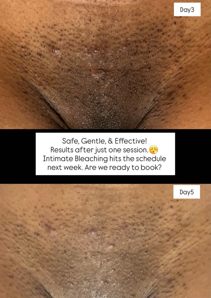 Intimate Brightening: Bikini Area