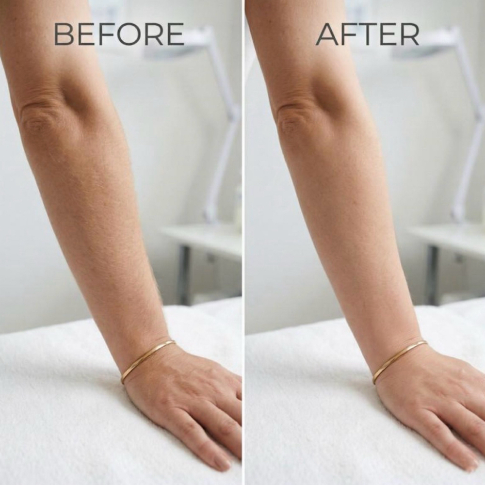 Laser Package Half Arms (6) at La Belle Studio by Soraya in Woburn, MA