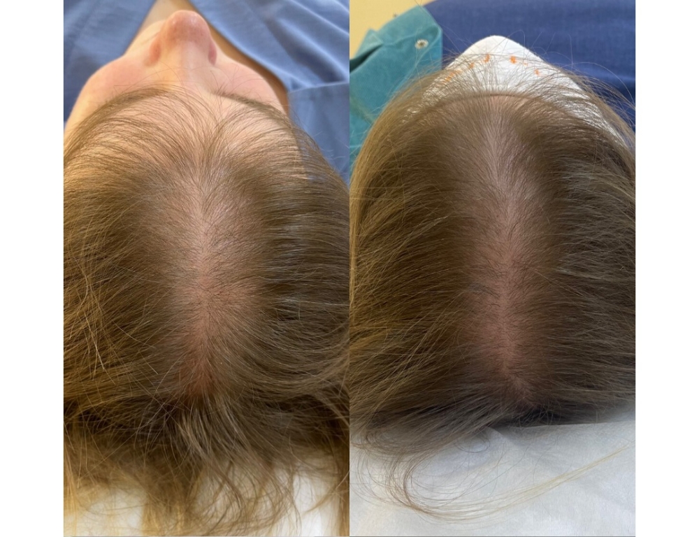 cold plasma. Hair loss