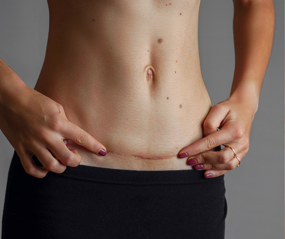 Post-Op Ocean Flow Healing (MLD)