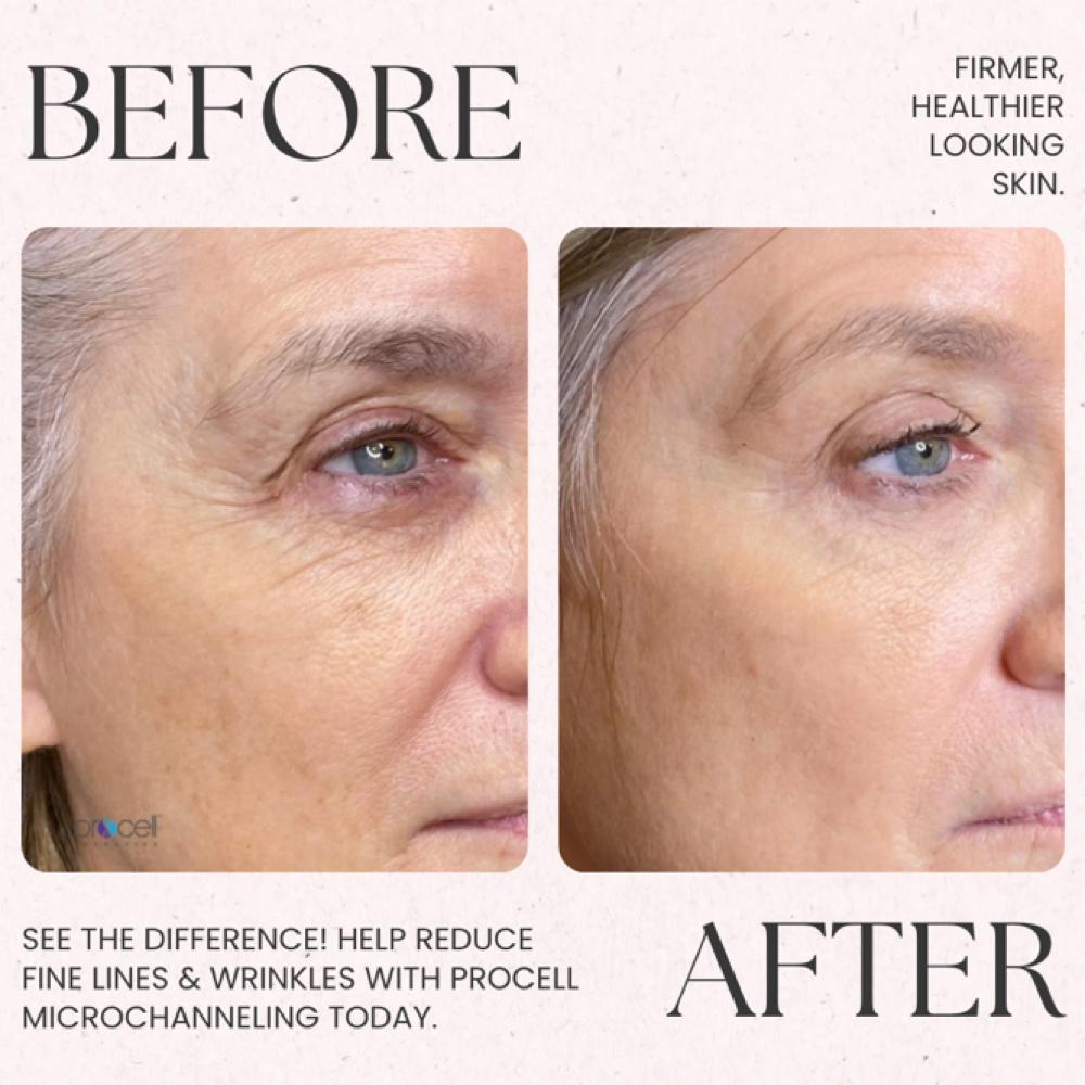 Procell Microchanneling at LUMI Beauty Lounge in Praireville, LA
