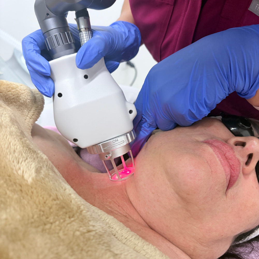 Neck Co2 Skin Resurfacing at Skin Commitment LLC in Brownsville Tx, TX