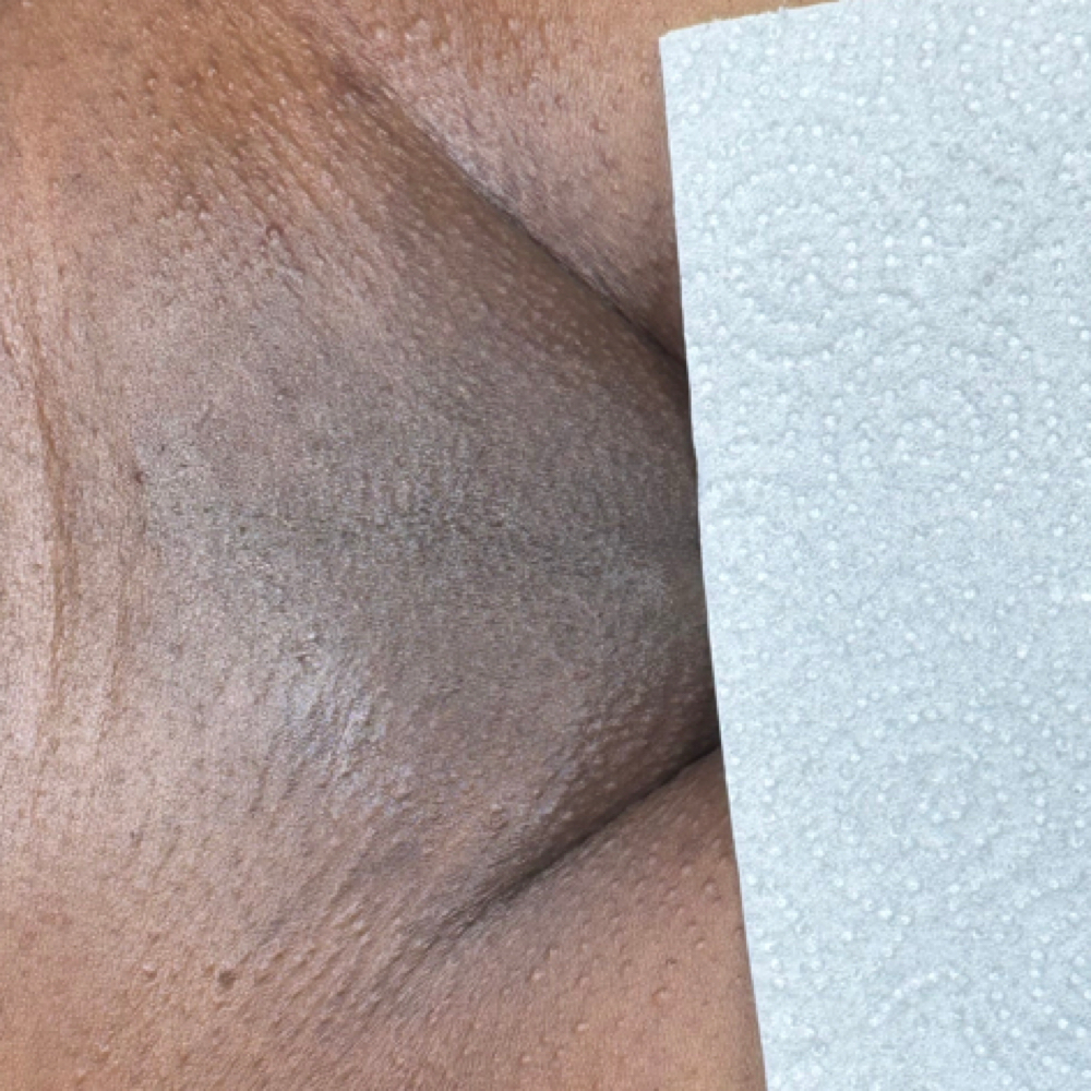 🩶 4-6 WEEK Brazilian Wax at Pure Beauty in Oak Lawn, IL