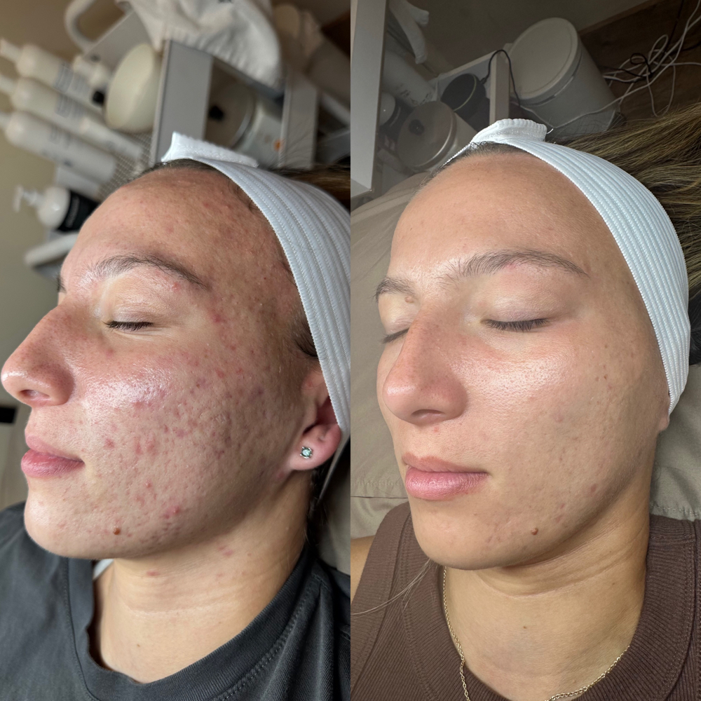 Acne Bootcamp Consult + Peel