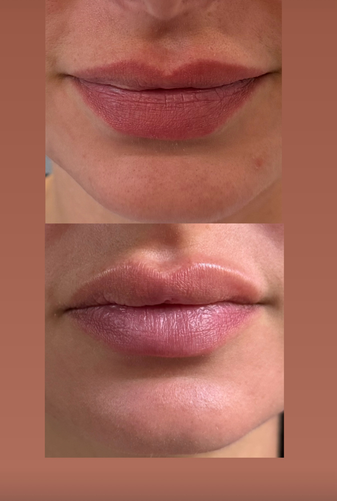 Lip flip