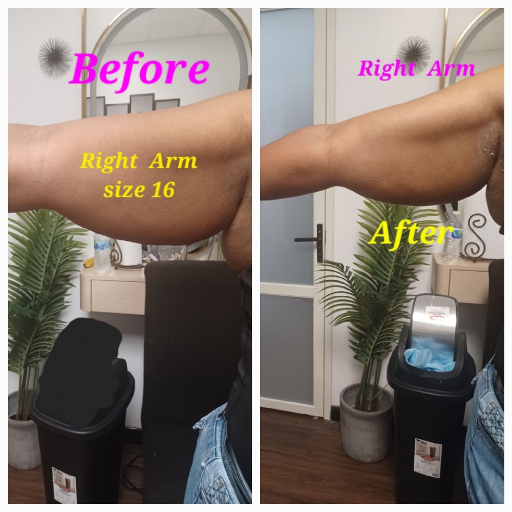 LIPO CAVITATION  ARMS