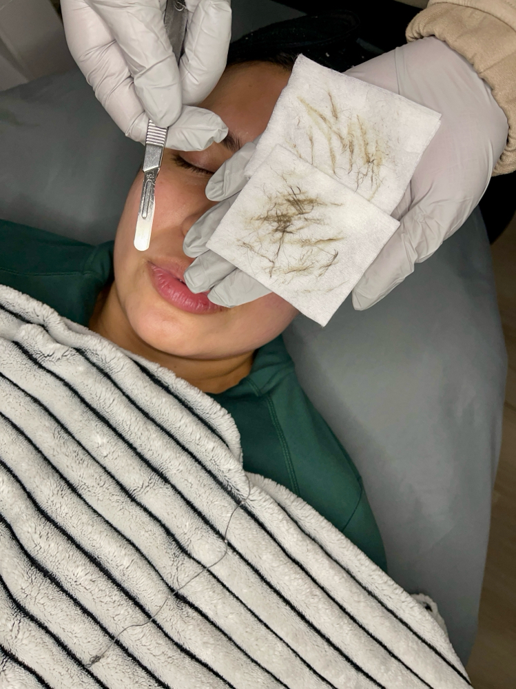 Dermaplaning