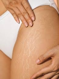 Ink-Less Stretch Marks