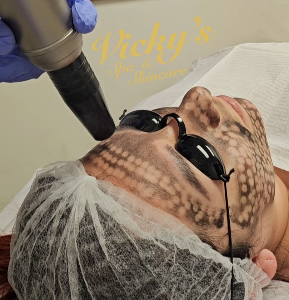 Hollywood Peel