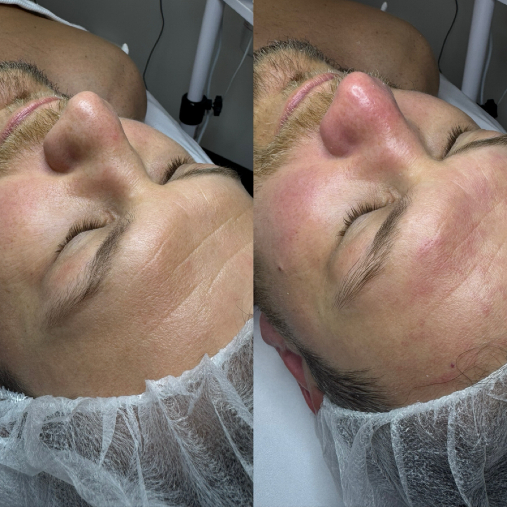 Men’s Skin Reset at Healthy skin by Alvina in Highland Park, IL
