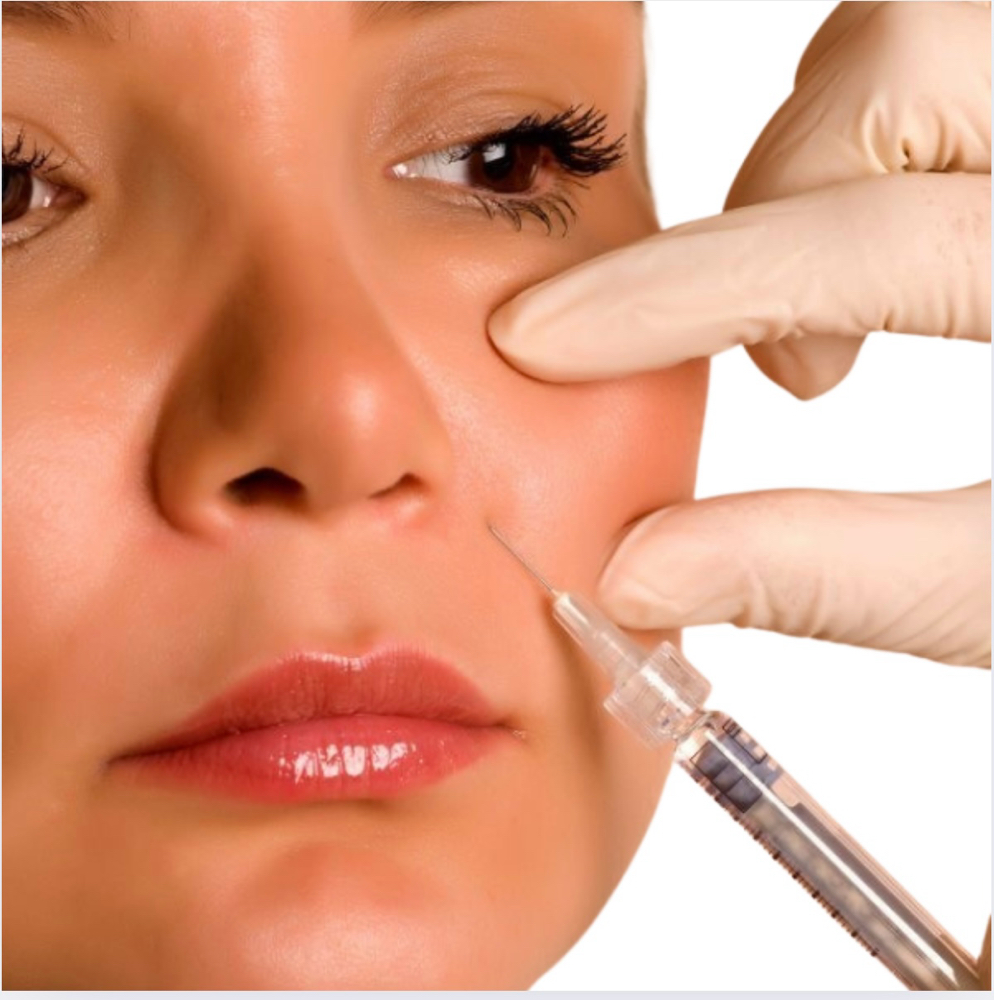 Smile Line/Nasolabia Fold Filler