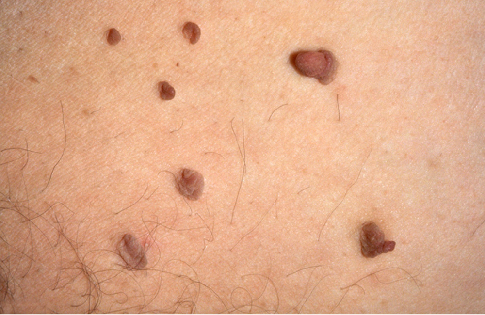 Skin Tag Removal (underarm)