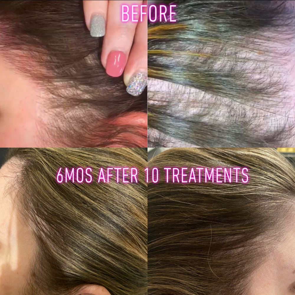 Hya Anti-Hair Loss Treatment