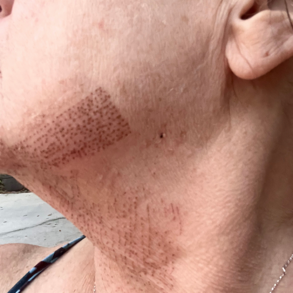 Fibroblast Neck Tightening at Skin Fixation & Esthetic Training in Port Saint Lucie, FL