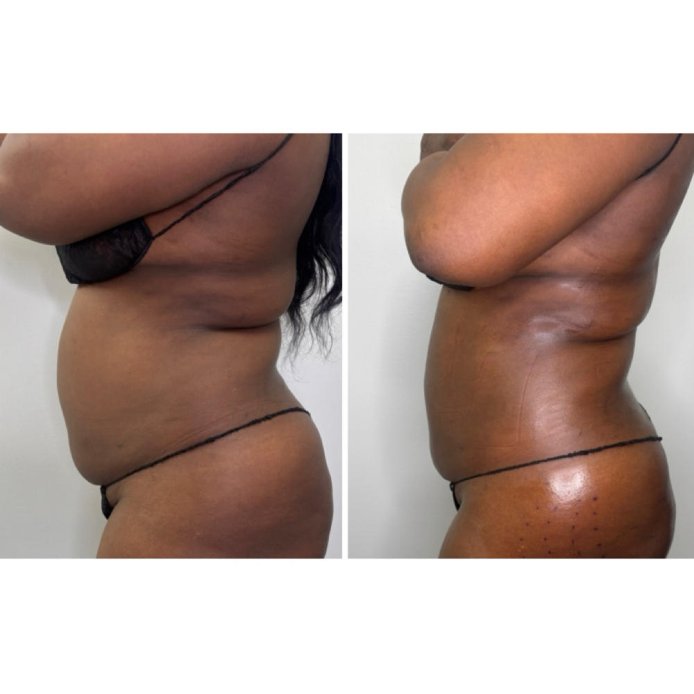 360 Lipo at Extreme Body Scultping in Edgewood, MD